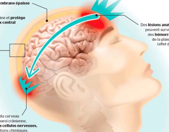 Les commotions cérébrales triplent le risque de suicide chez les adultes